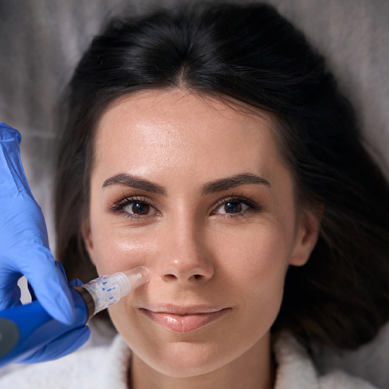 Microneedling close up