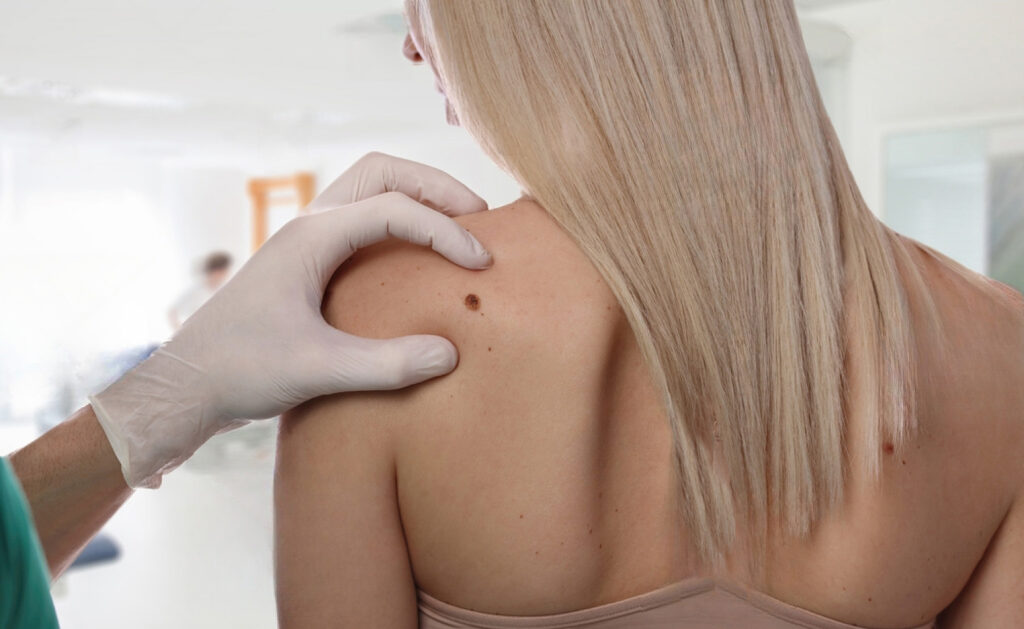 Mole Removal